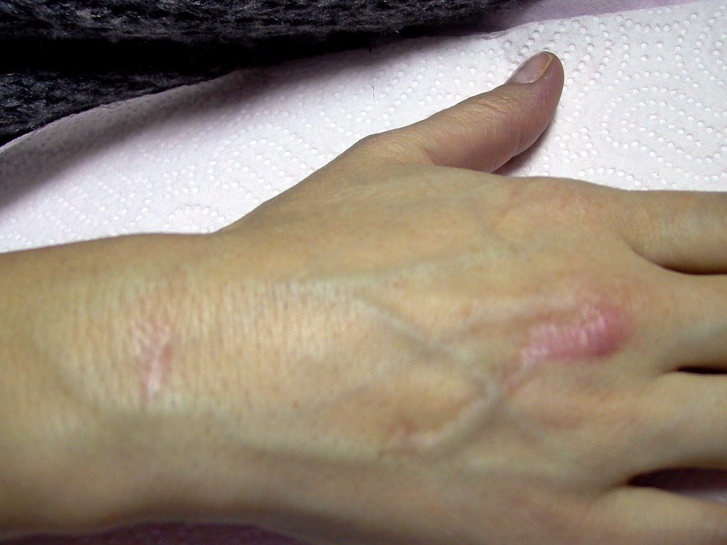 Tretman ožiljka na ruci nastalog usled opekotina