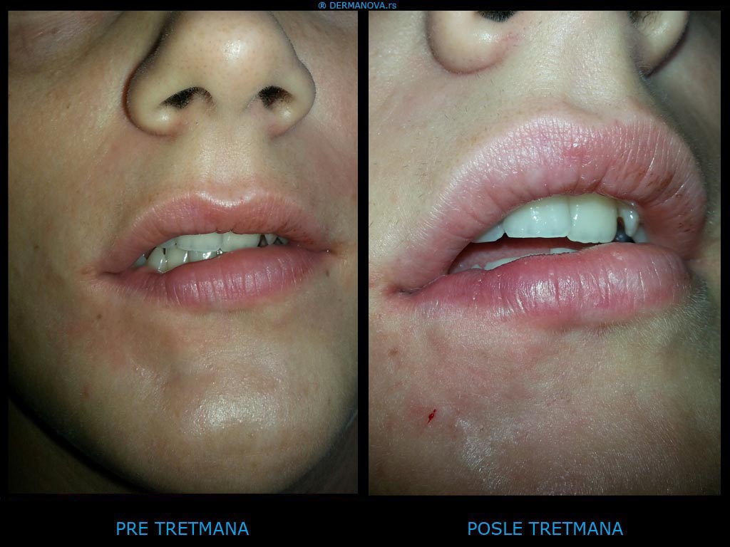 Defekt tkiva na bradi i korekcija asimetrije donje usne