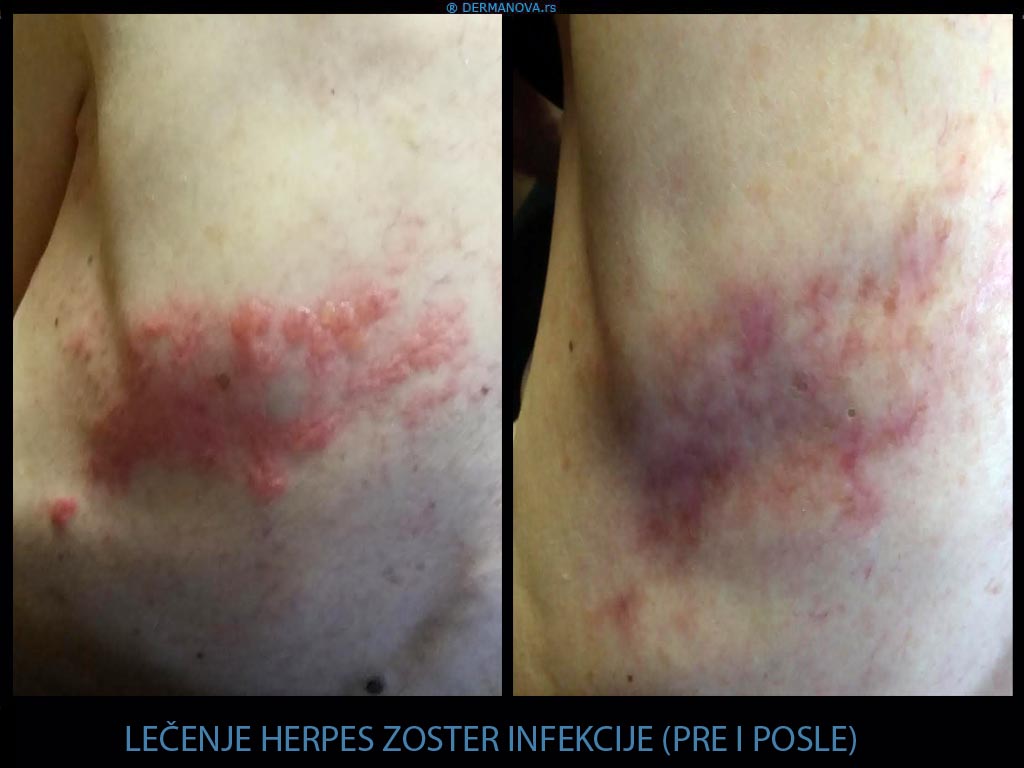 Lečenje herpes Zoster infekcije