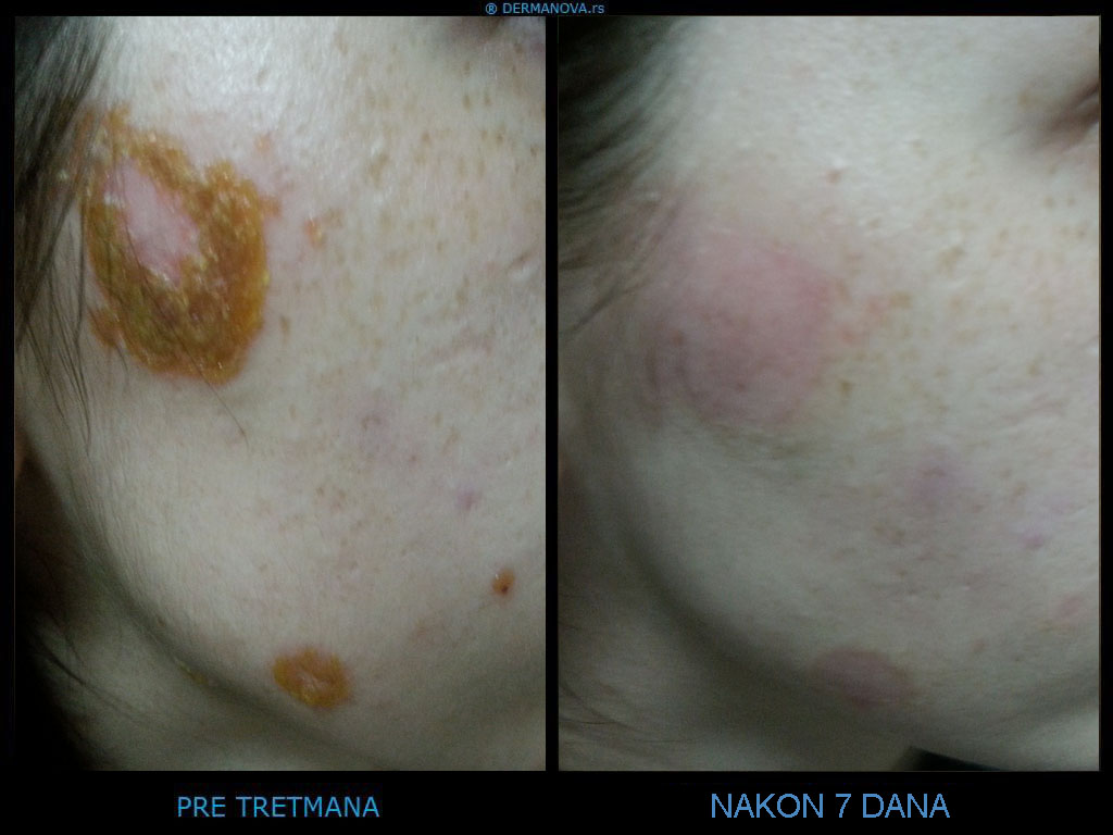 Tretman infekcije na koži